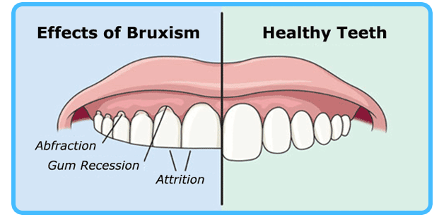 bruxism.png