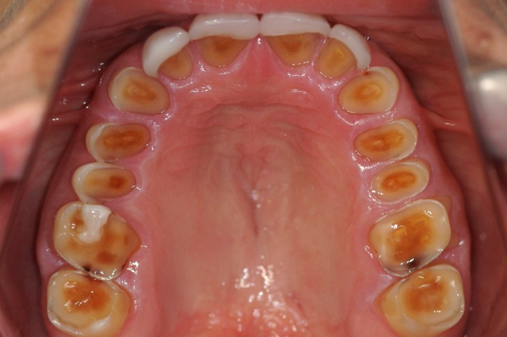 all-on-4-clinic_dental-implants-5103
